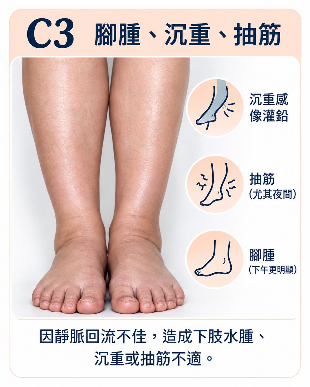 靜脈曲張第三期 C3：下肢水腫，腳踝腫脹，伴隨沉重感與夜間抽筋。