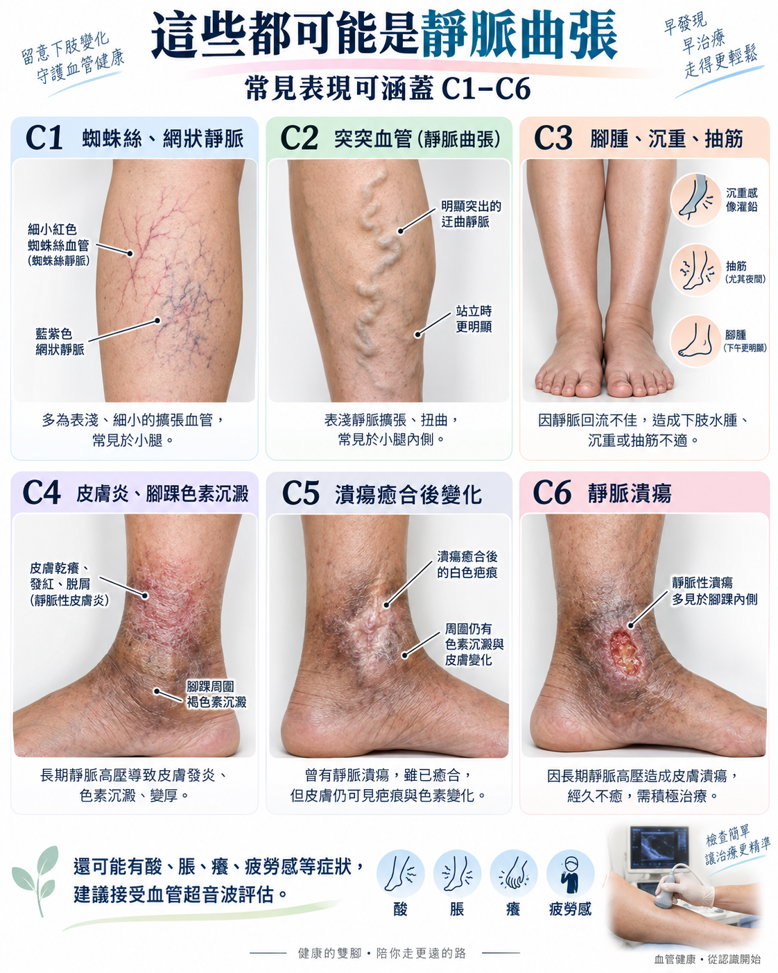 靜脈曲張 C1 至 C6 常見表現圖鑑：C1 蜘蛛絲與網狀靜脈、C2 突出曲張血管、C3 腳腫沉重抽筋、C4 皮膚炎與腳踝色素沉澱、C5 潰瘍癒合後變化、C6 靜脈潰瘍，並建議接受血管超音波評估。